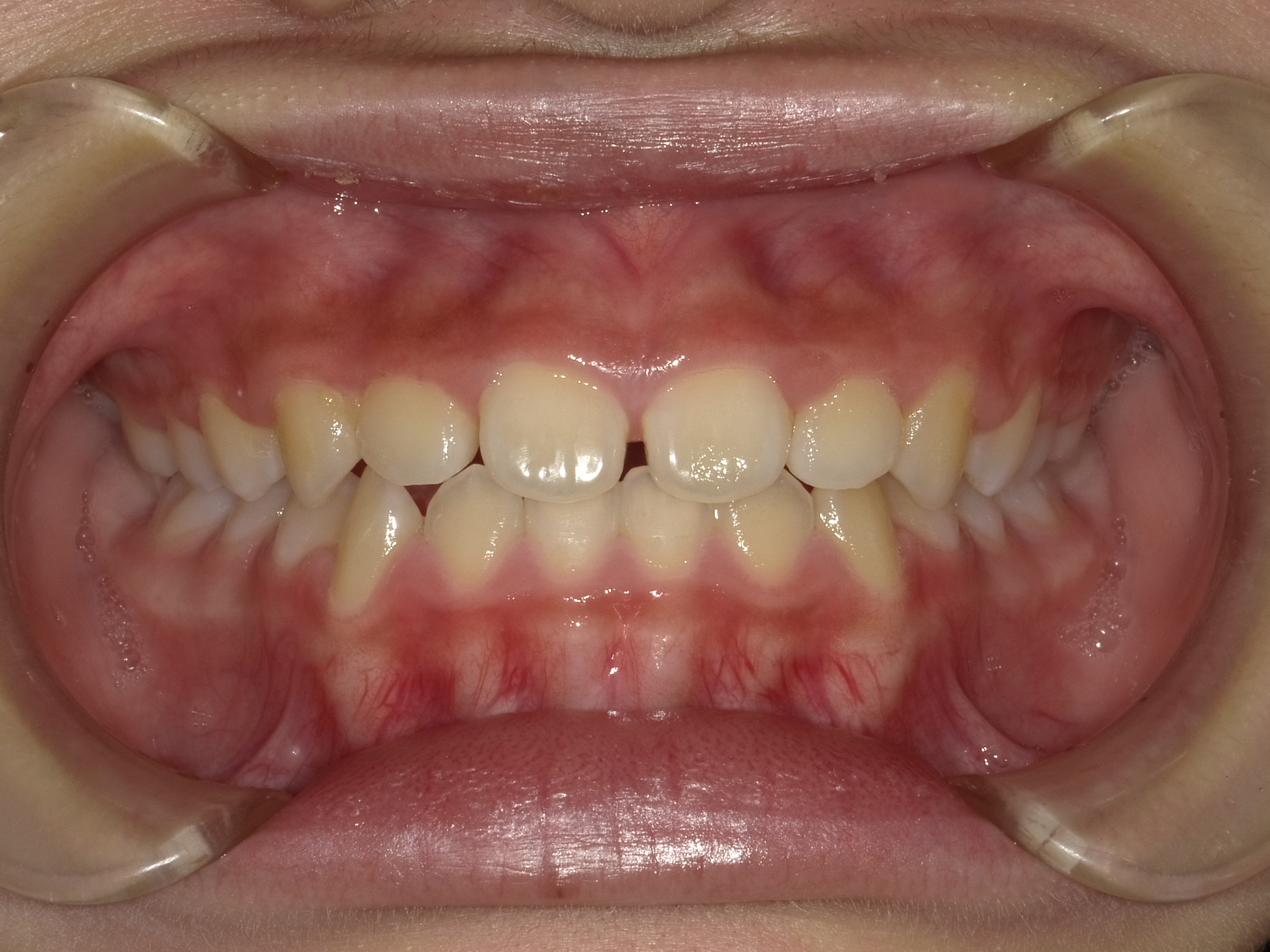 症例集　予防矯正　正面