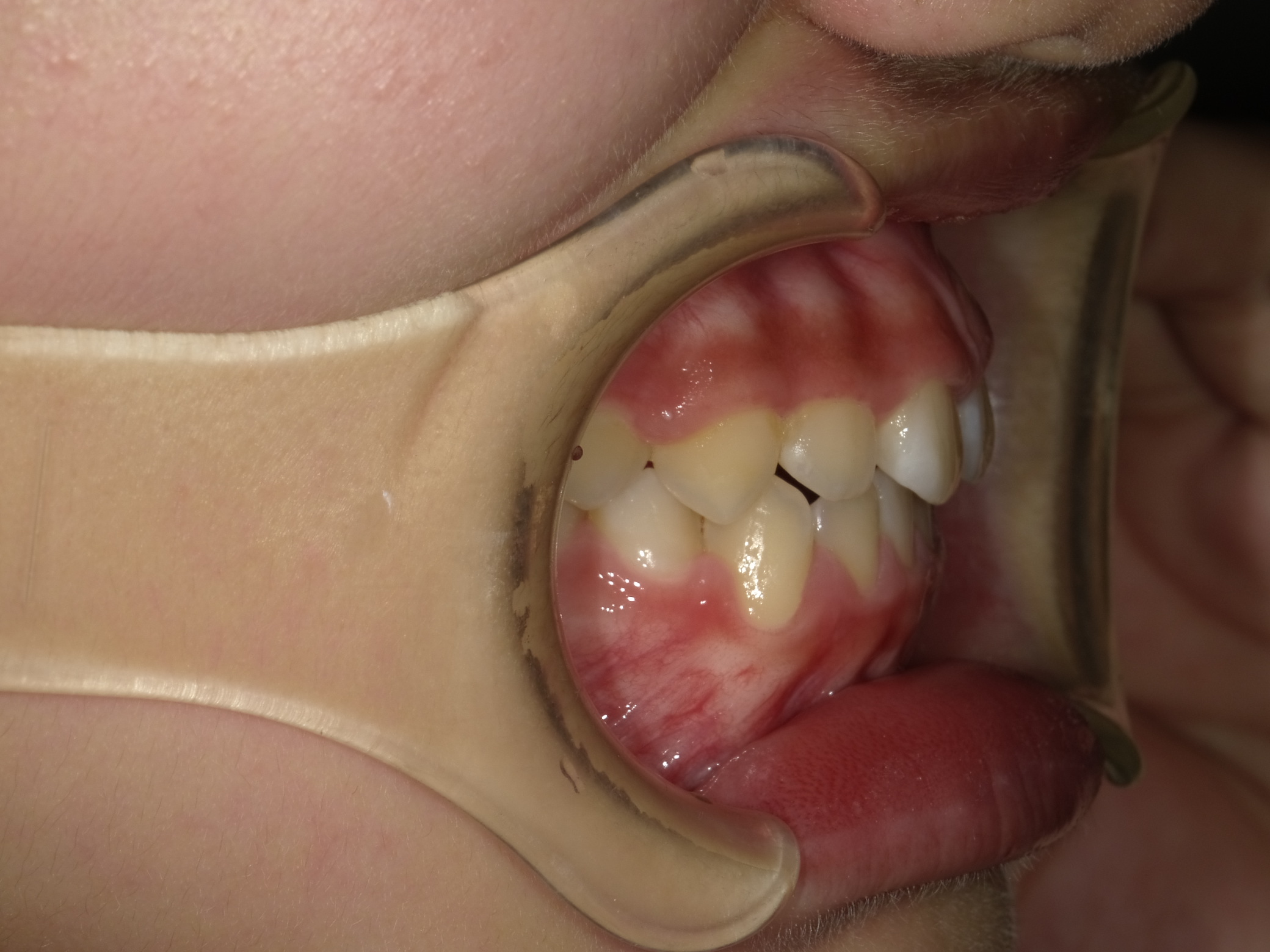 症例集　予防矯正　右横