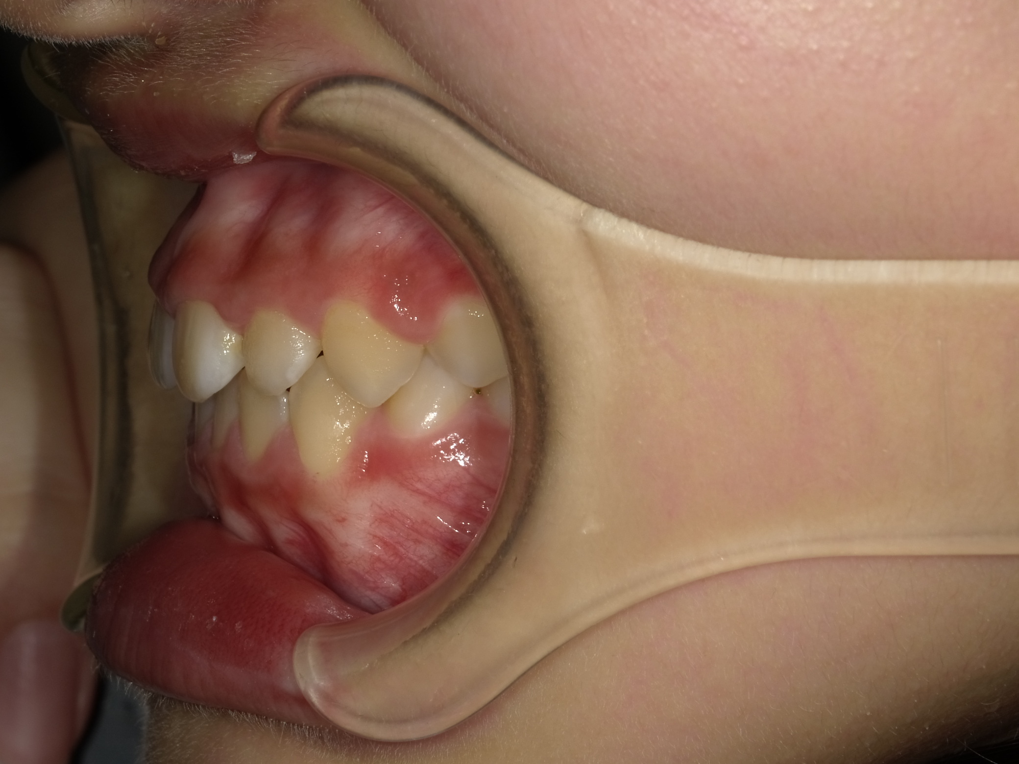 症例集　予防矯正　左横