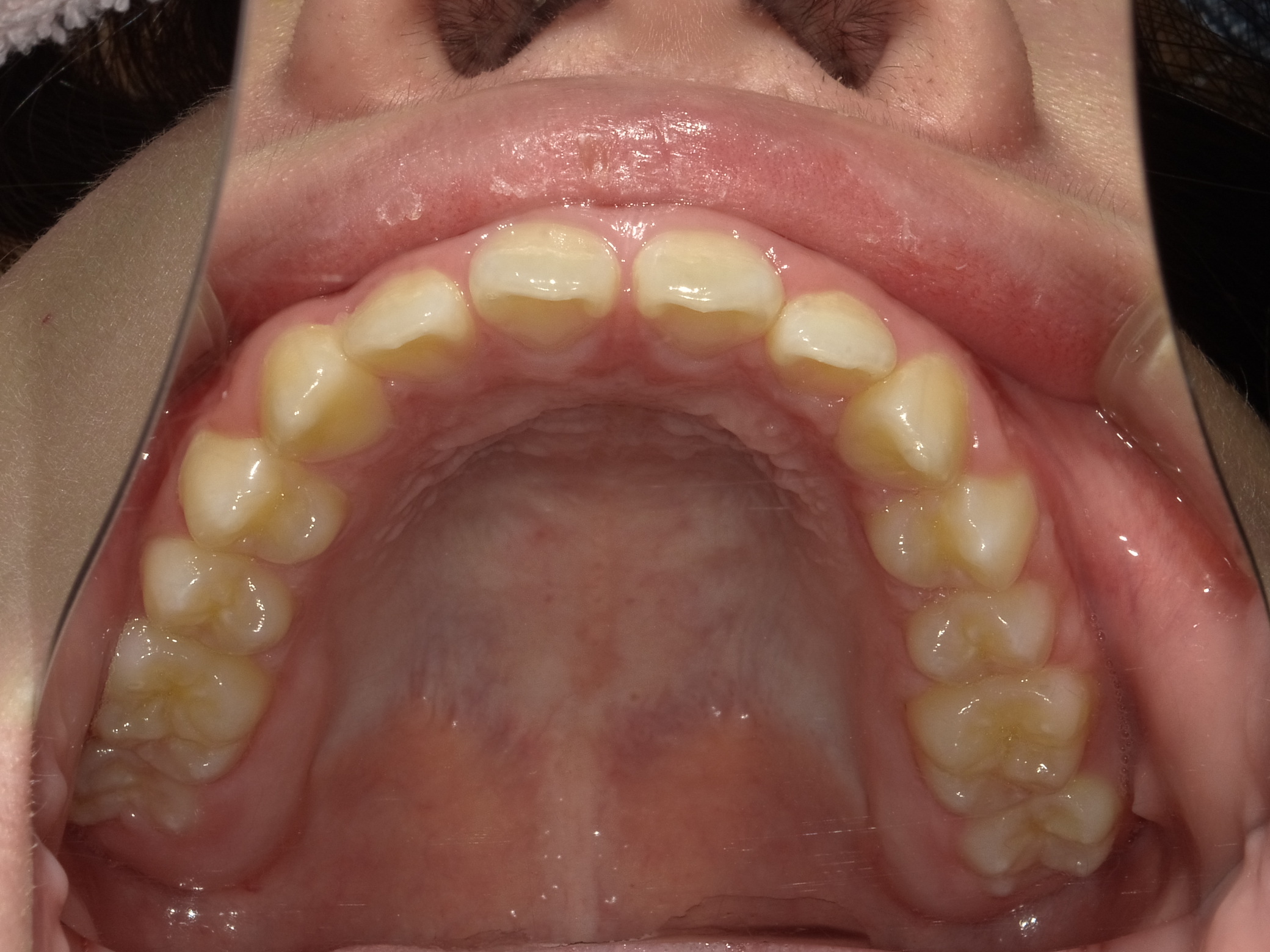 症例集　予防矯正　上顎