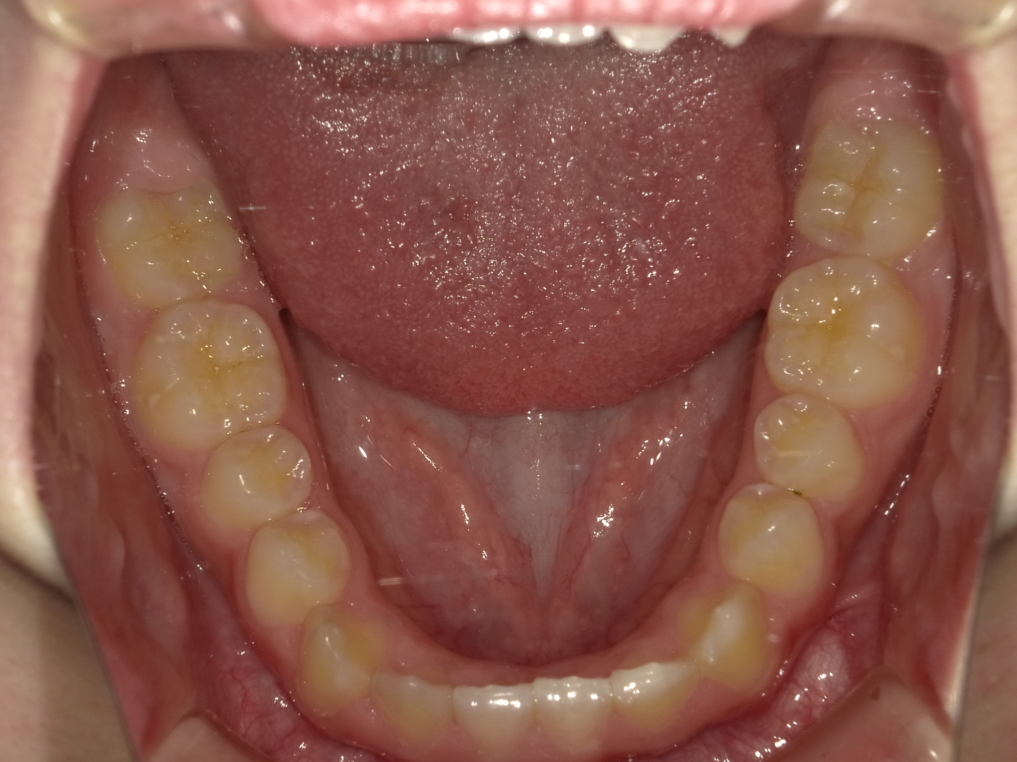 症例集　予防矯正　下顎