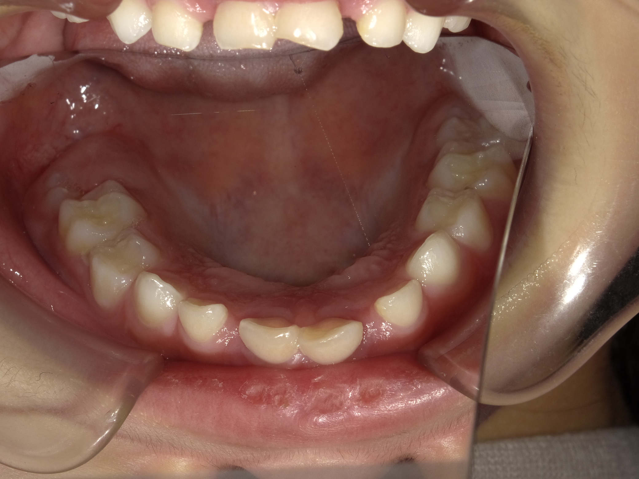 症例集　予防矯正　下顎