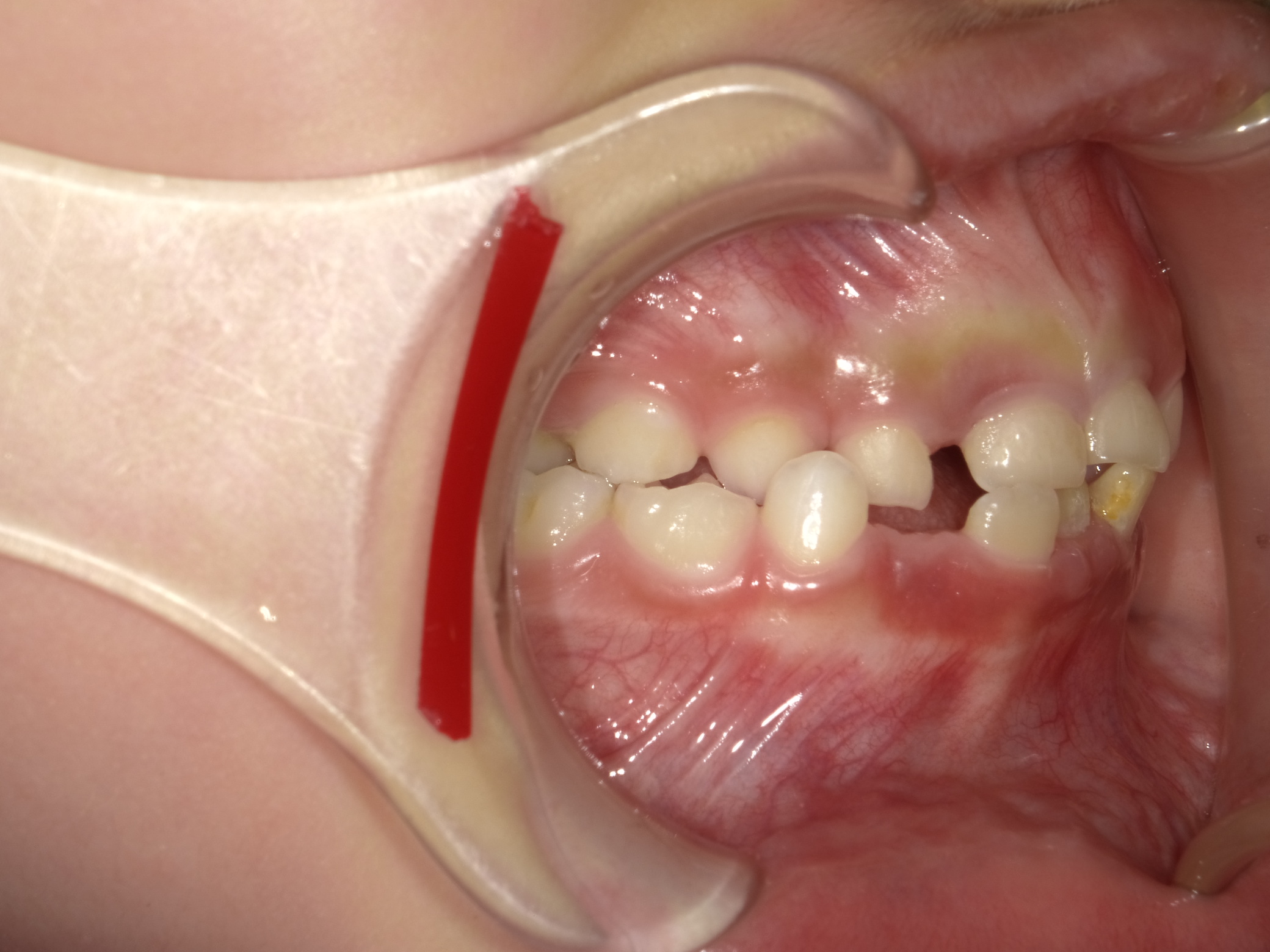 症例集　予防矯正　右横