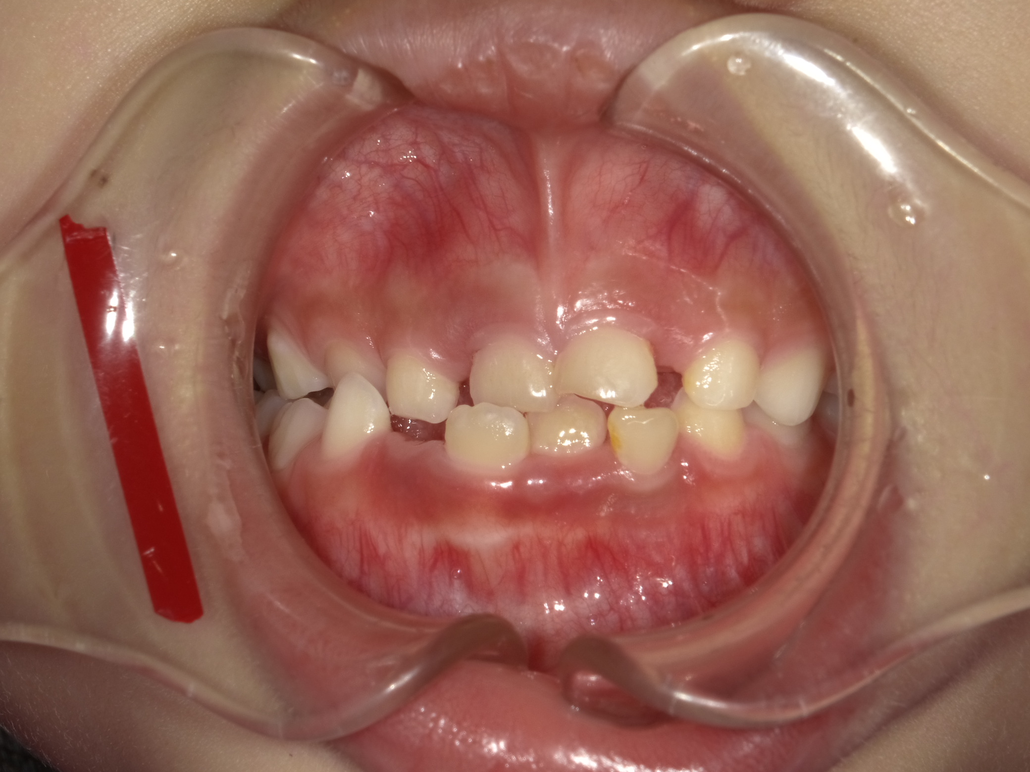 症例集　予防矯正　正面