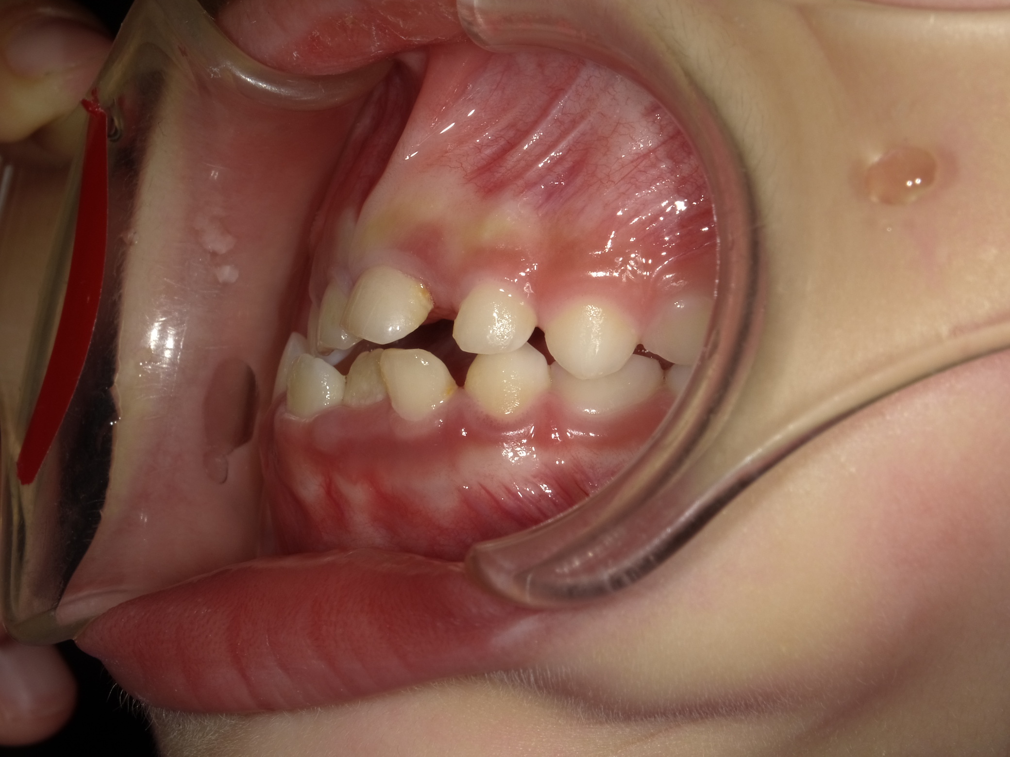 症例集　予防矯正　左横