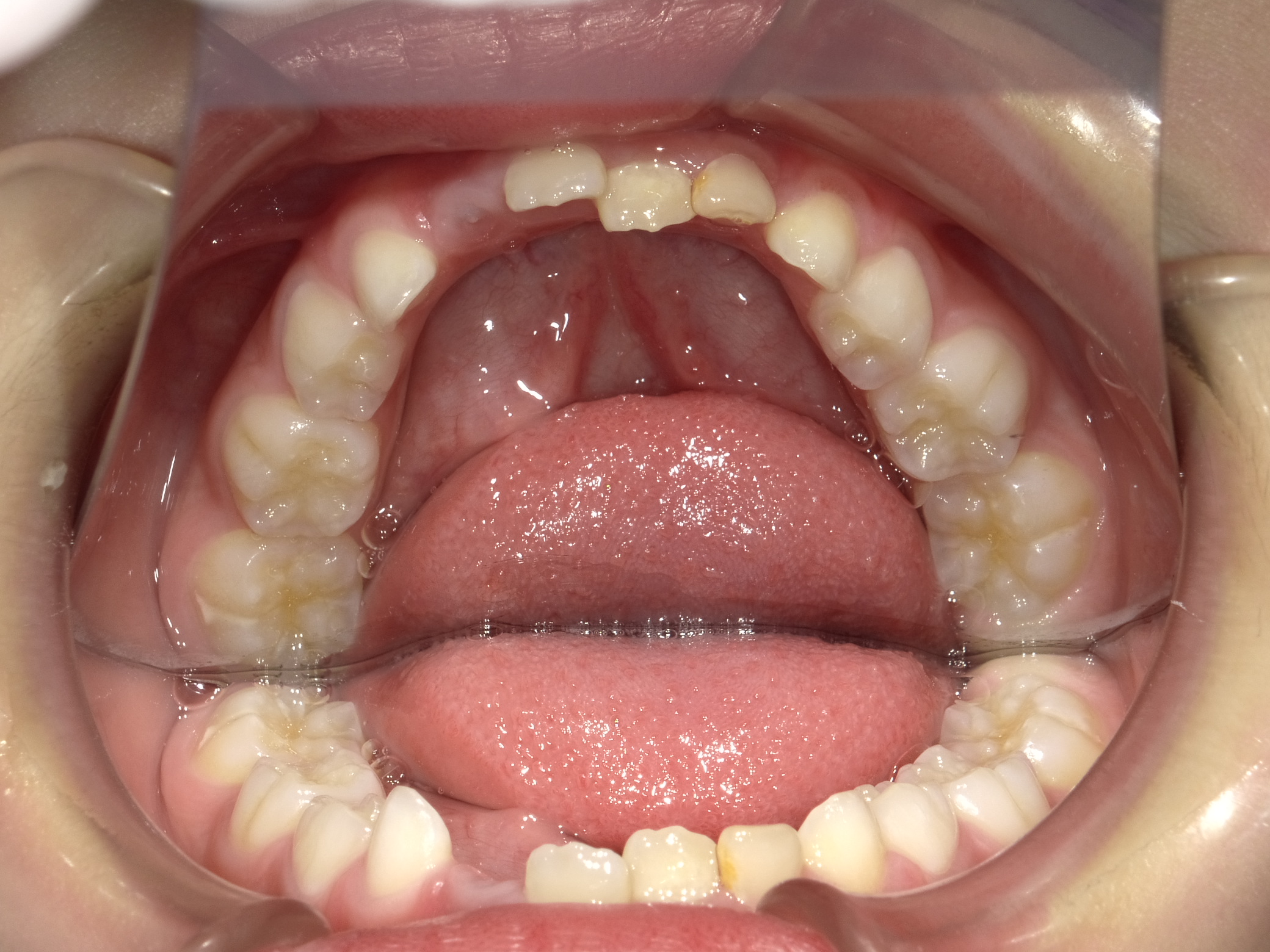 症例集　予防矯正　上顎