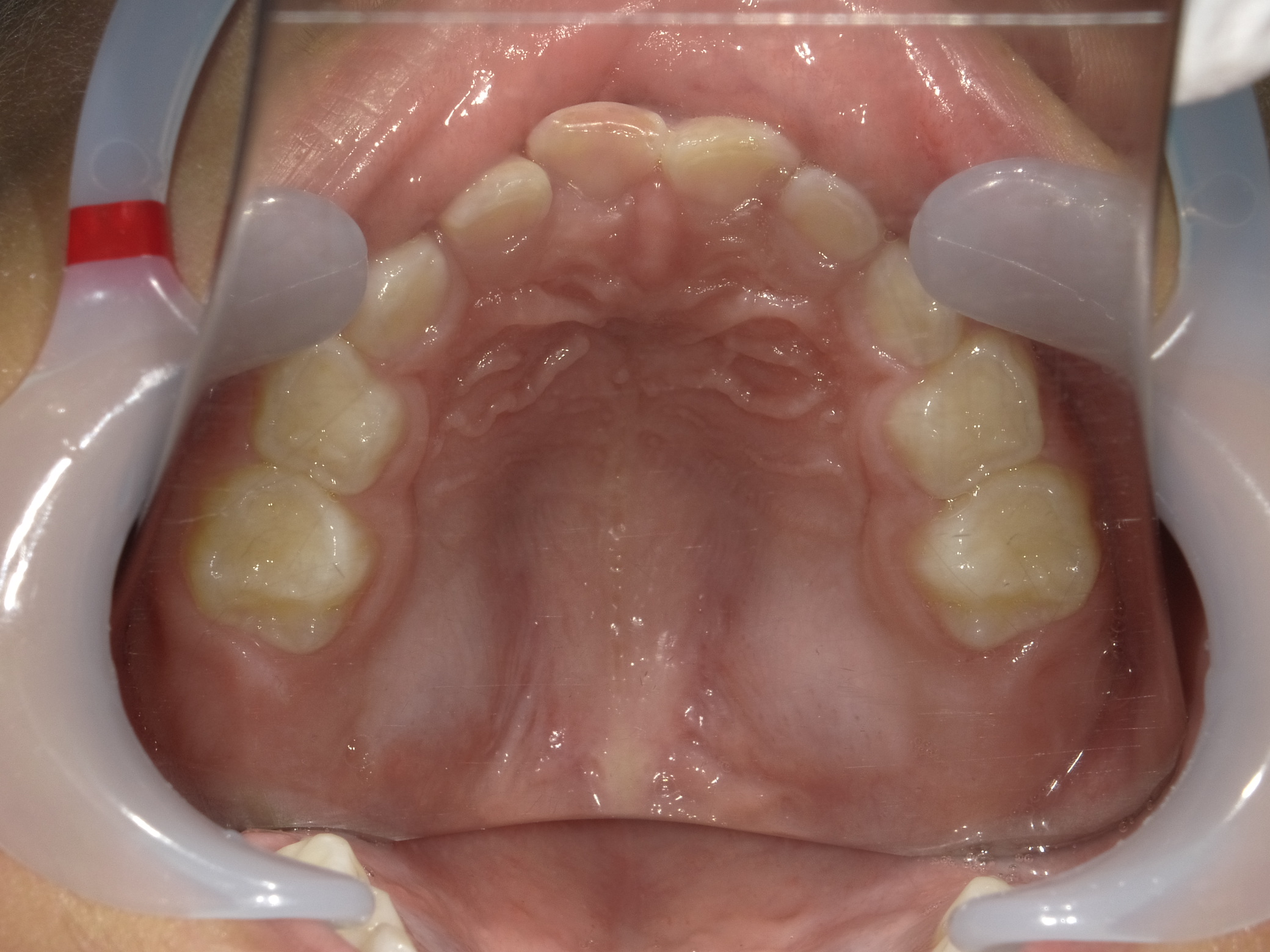 症例集　予防矯正　上顎
