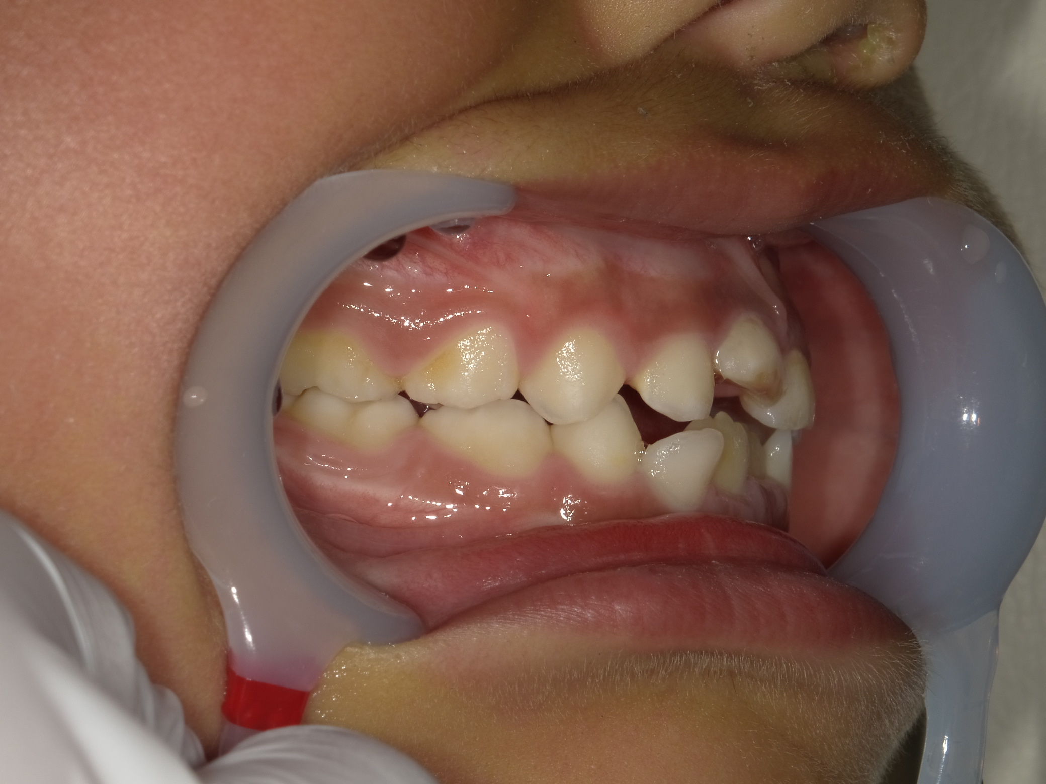 症例集　予防矯正　右横