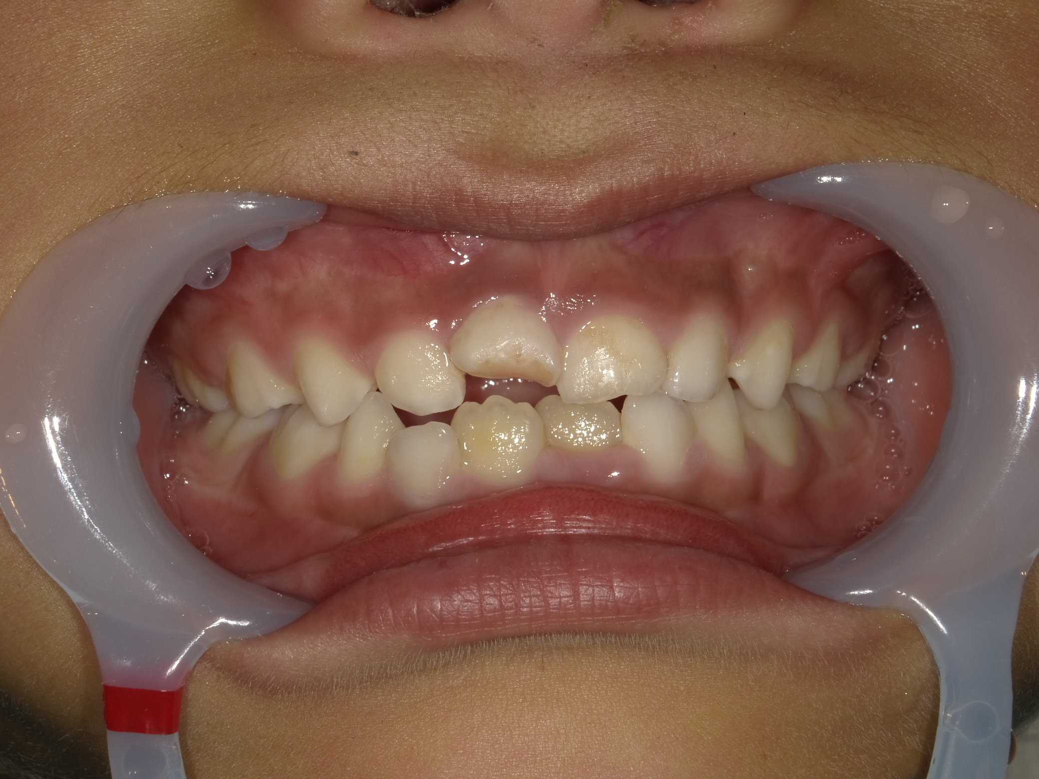 症例集　予防矯正　正面