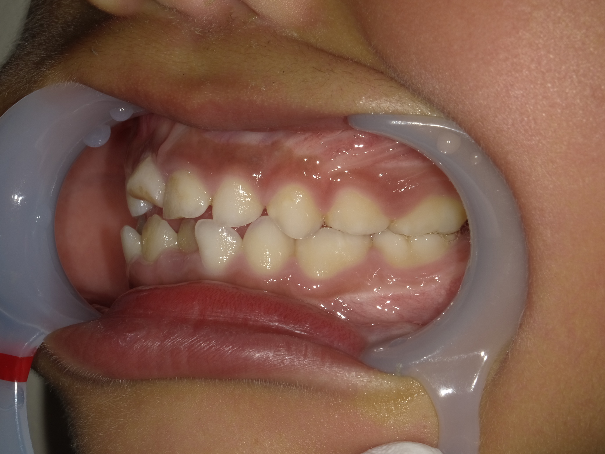 症例集　予防矯正　左横