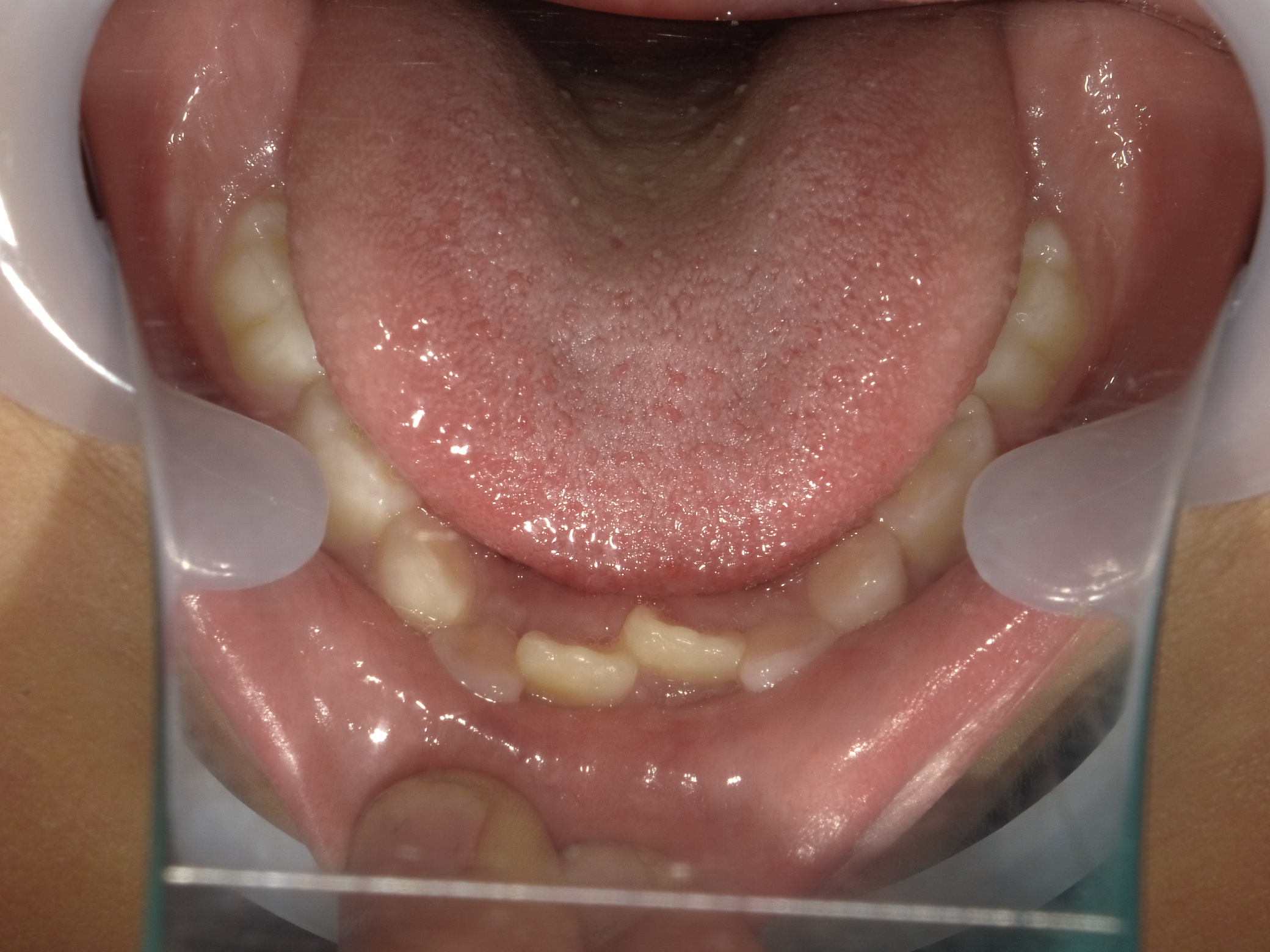 症例集　予防矯正　下顎