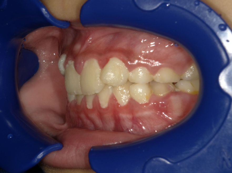 症例集　インビザライン　左横