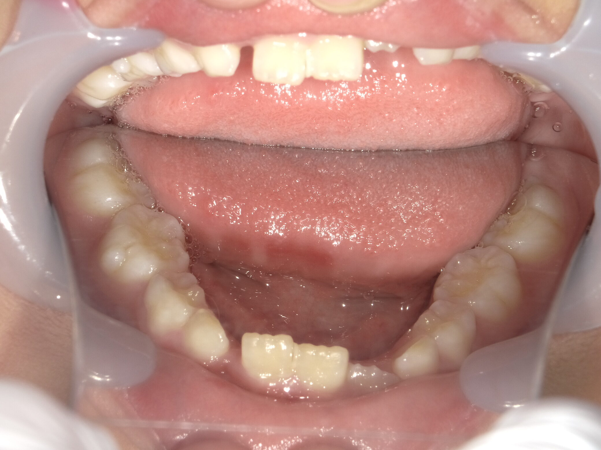 症例集 予防矯正 下顎