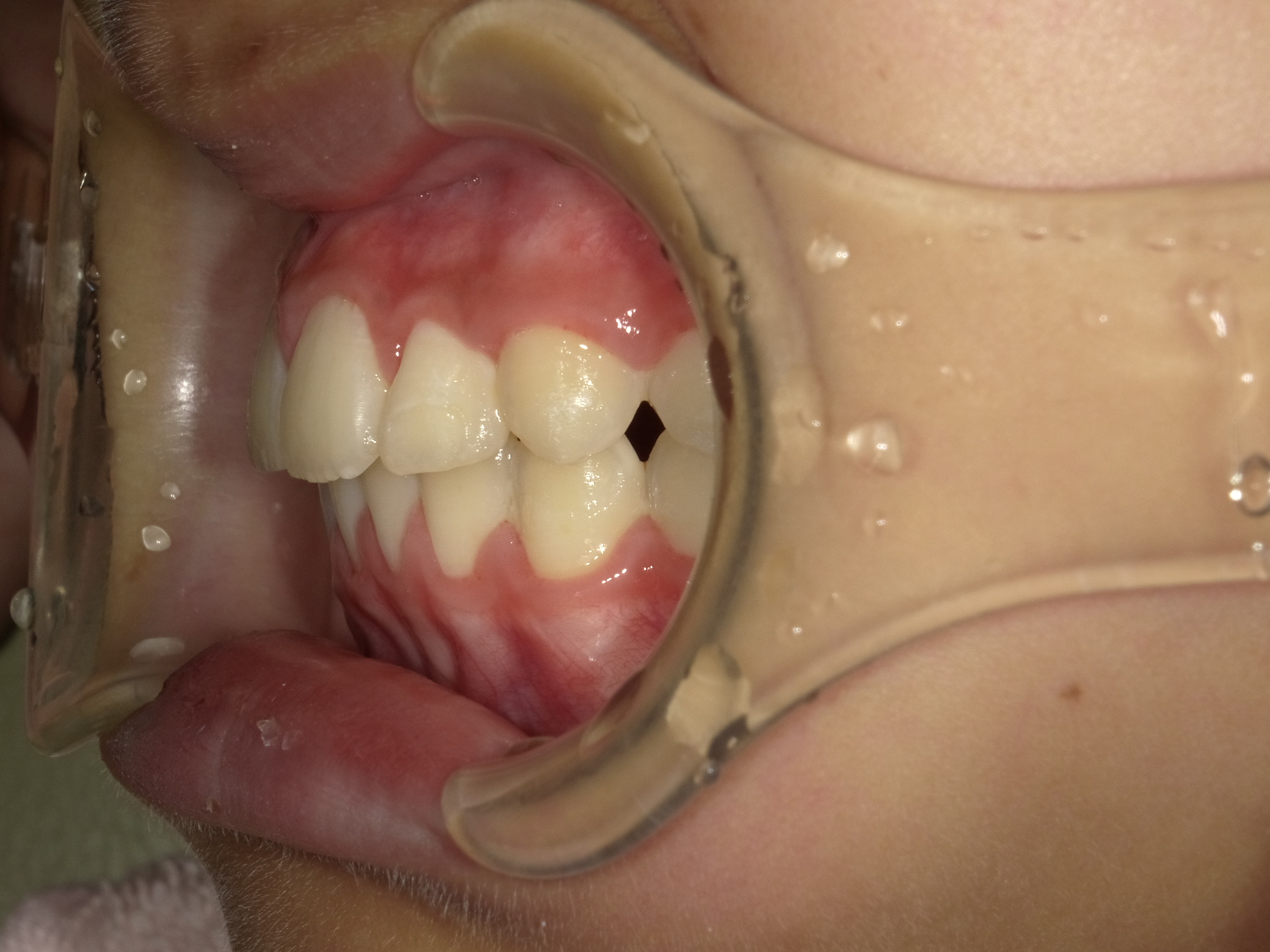 症例集　インビザライン　左横