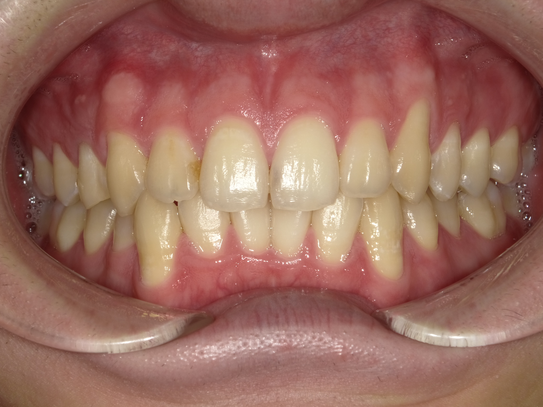 症例集　ホワイトニング　オフィス