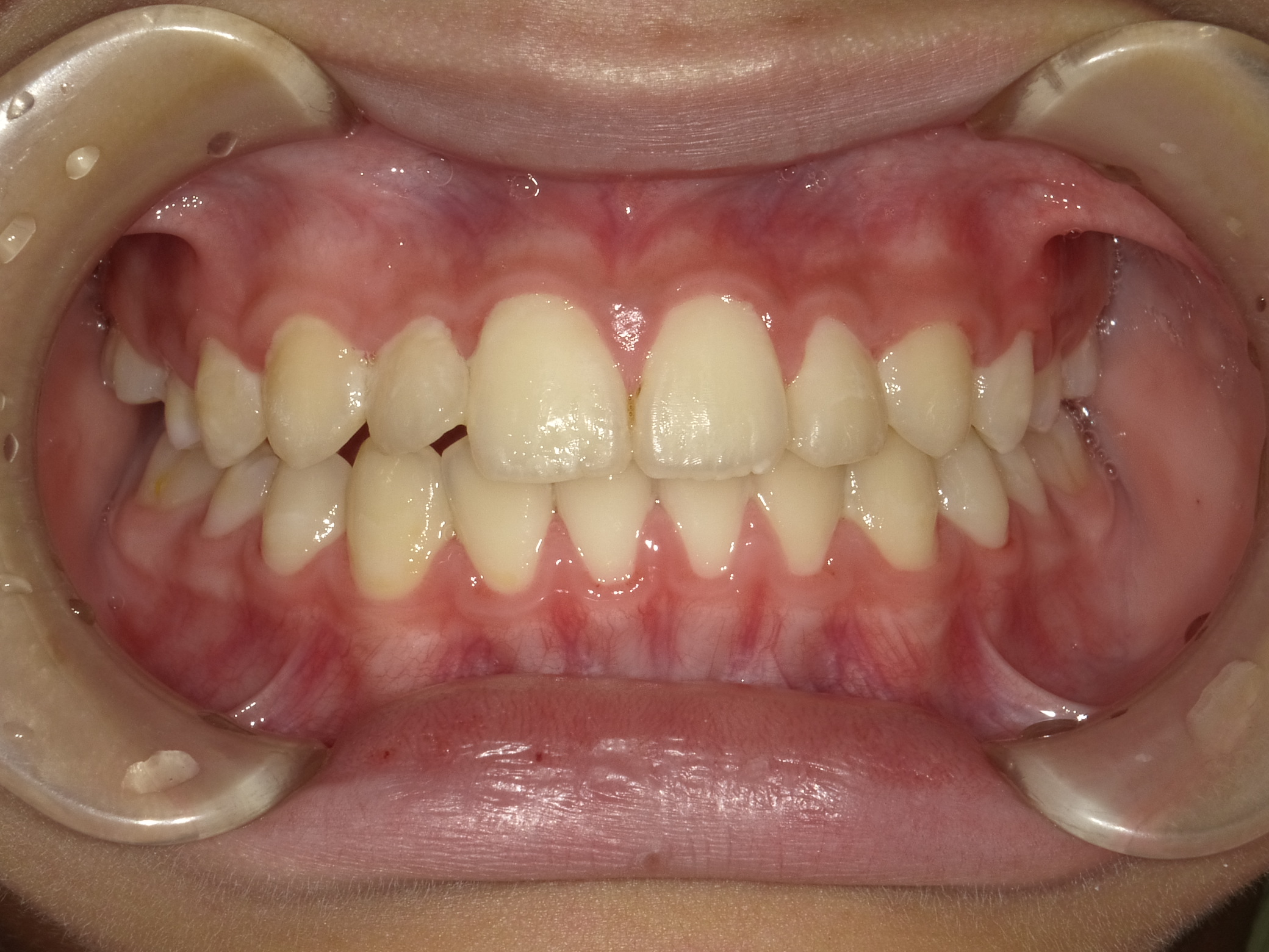 症例集　インビザライン　正面