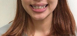症例集 インビザライン 笑顔