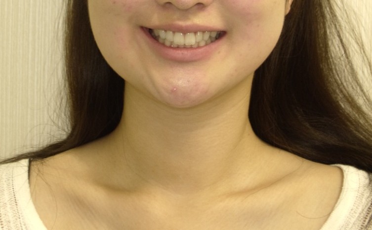 症例集　インビザライン　笑顔