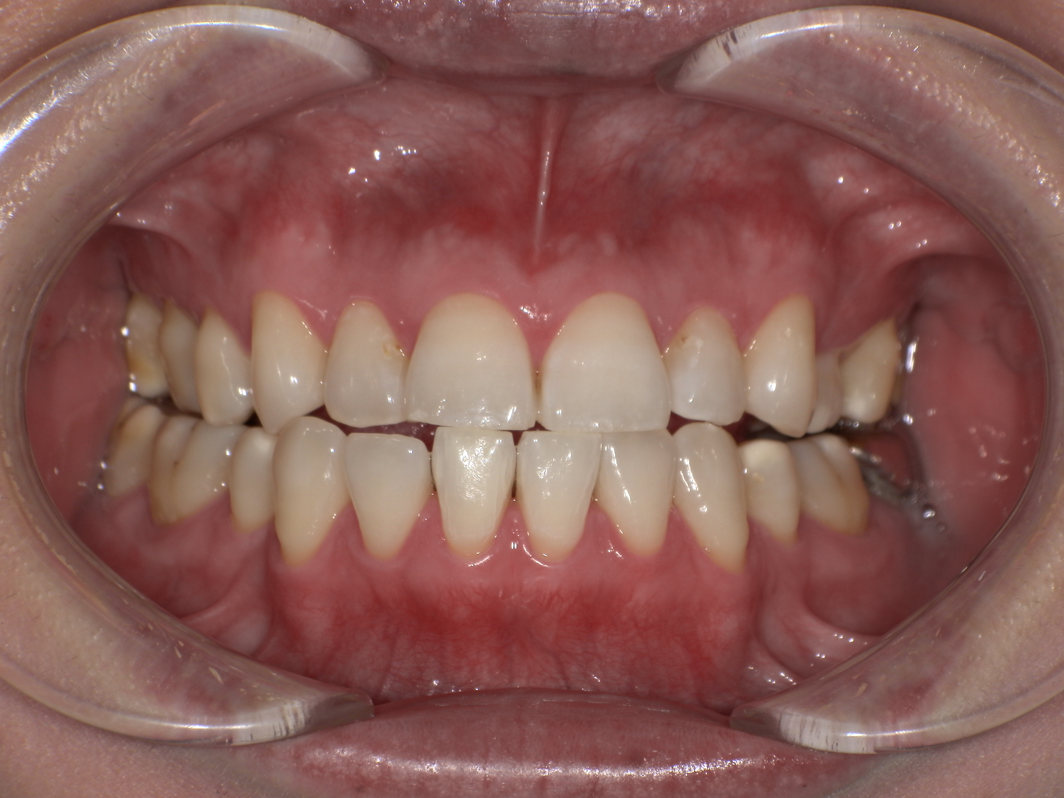 症例集　ホワイトニング　オフィス