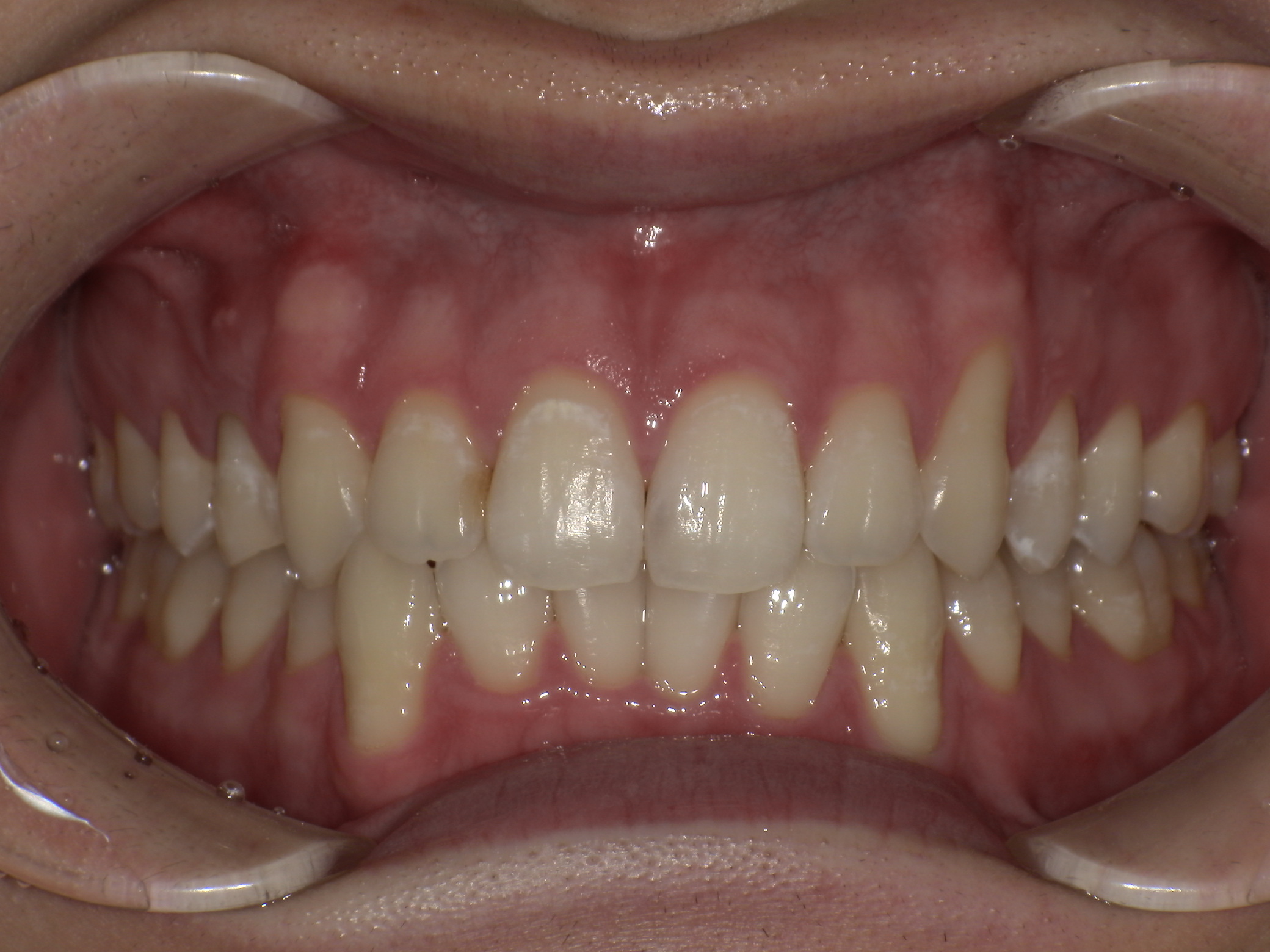 症例集　ホワイトニング　オフィス