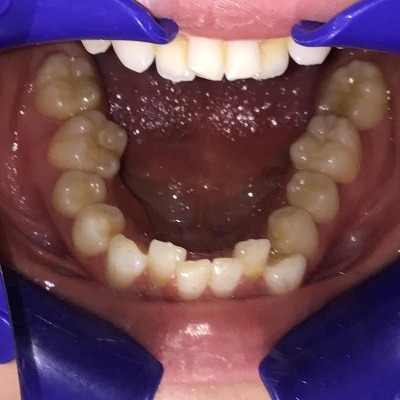 症例集　インビザライン　下顎