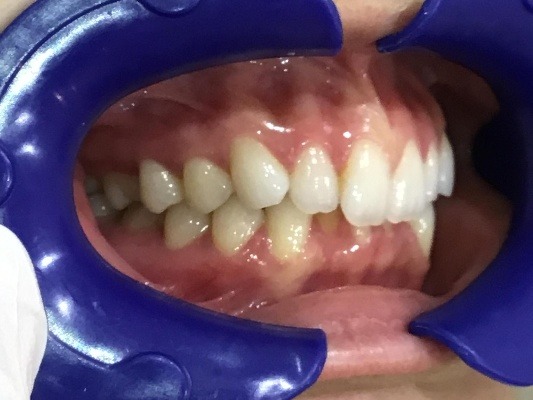 症例集　インビザライン　右横