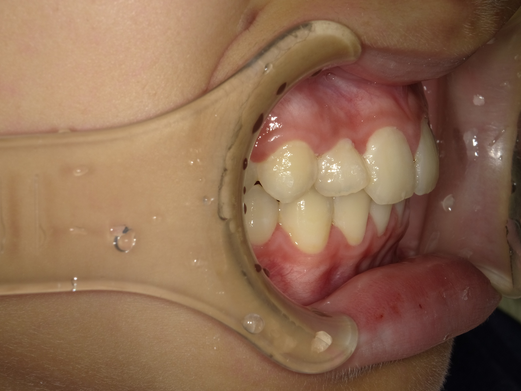 症例集　インビザライン　右横