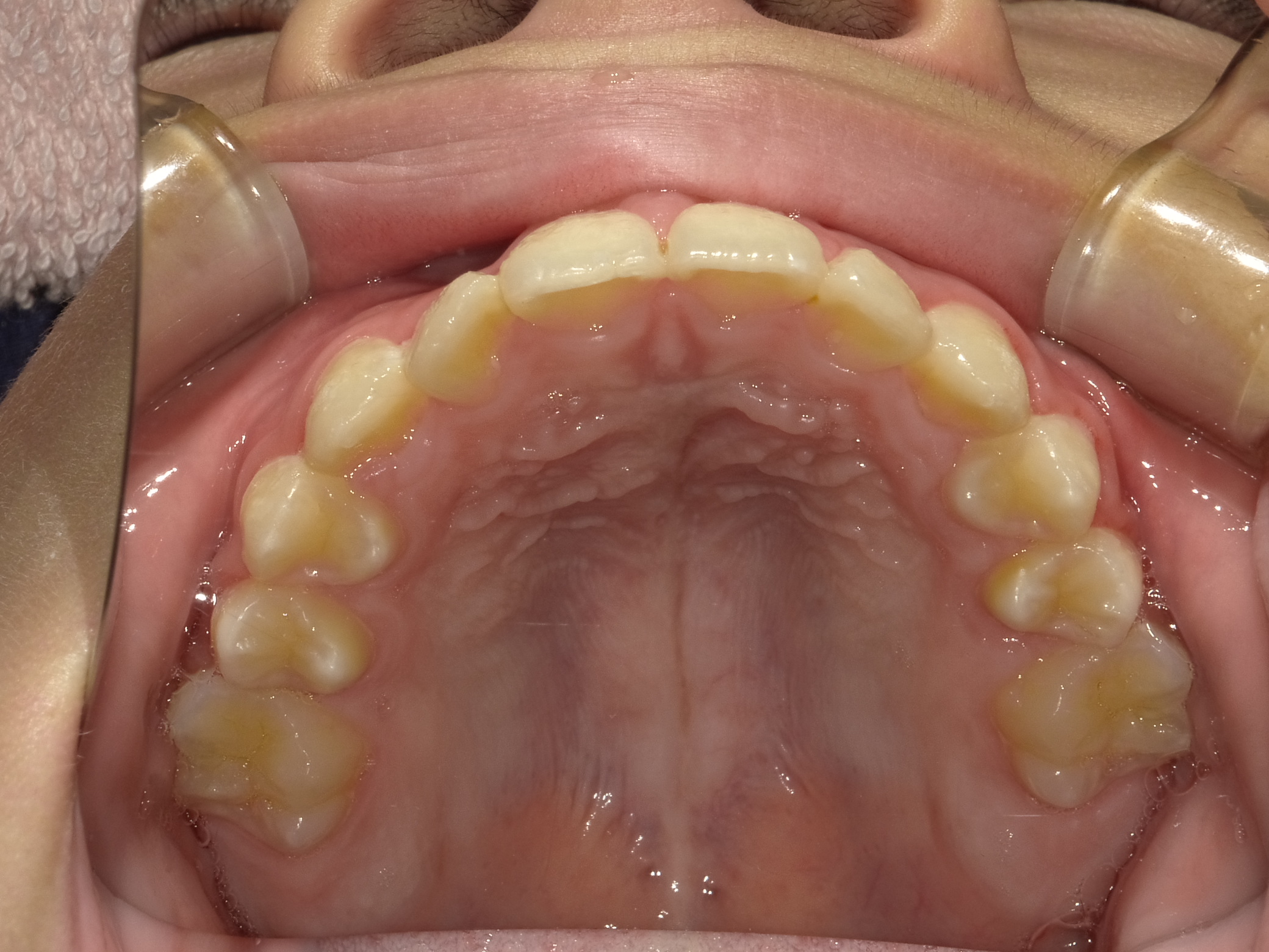 症例集　インビザライン　上顎