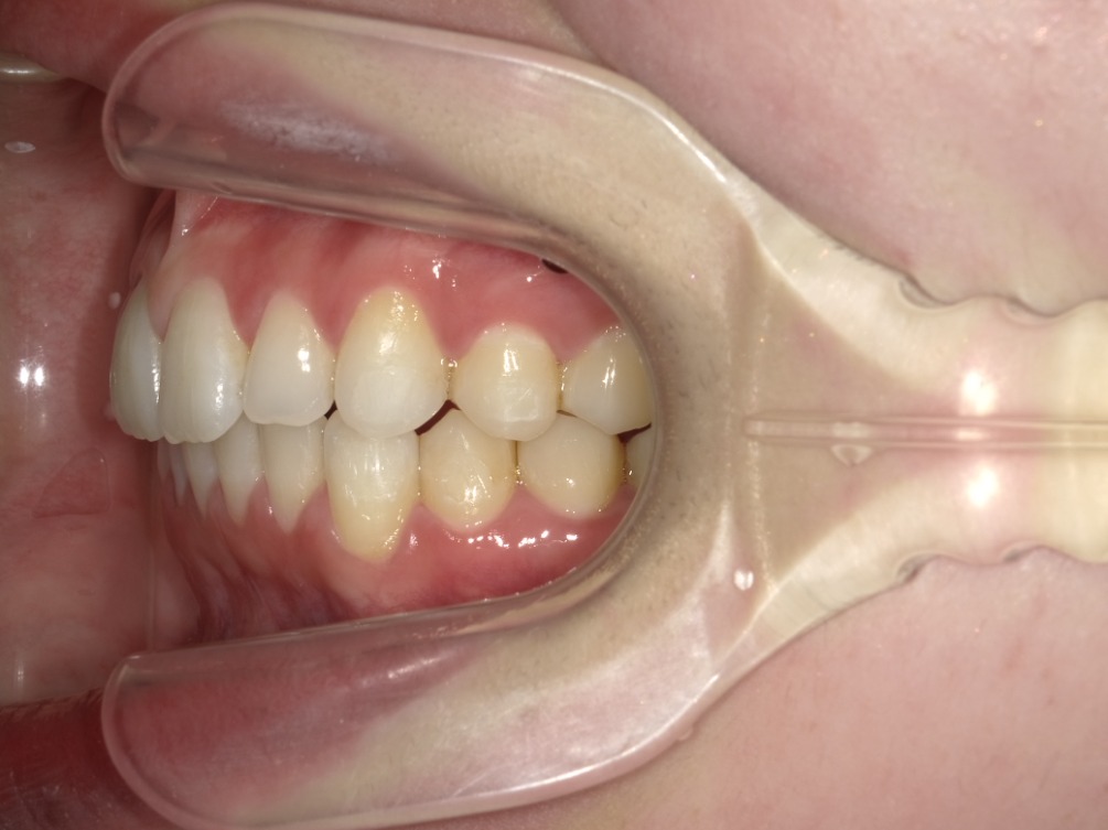 症例集　インビザライン　左横