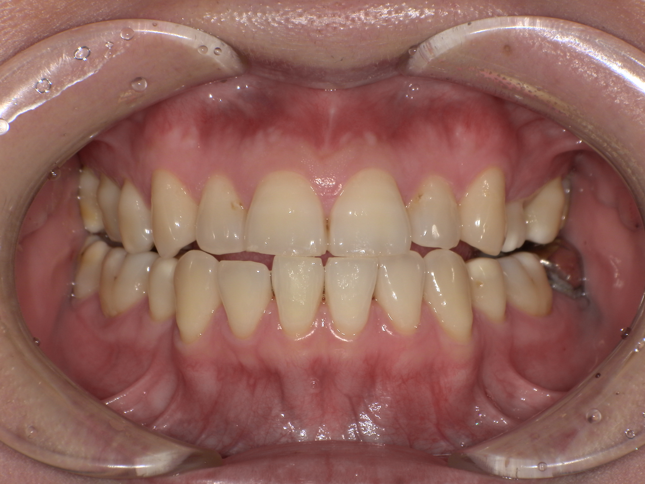 症例集　ホワイトニング　オフィス