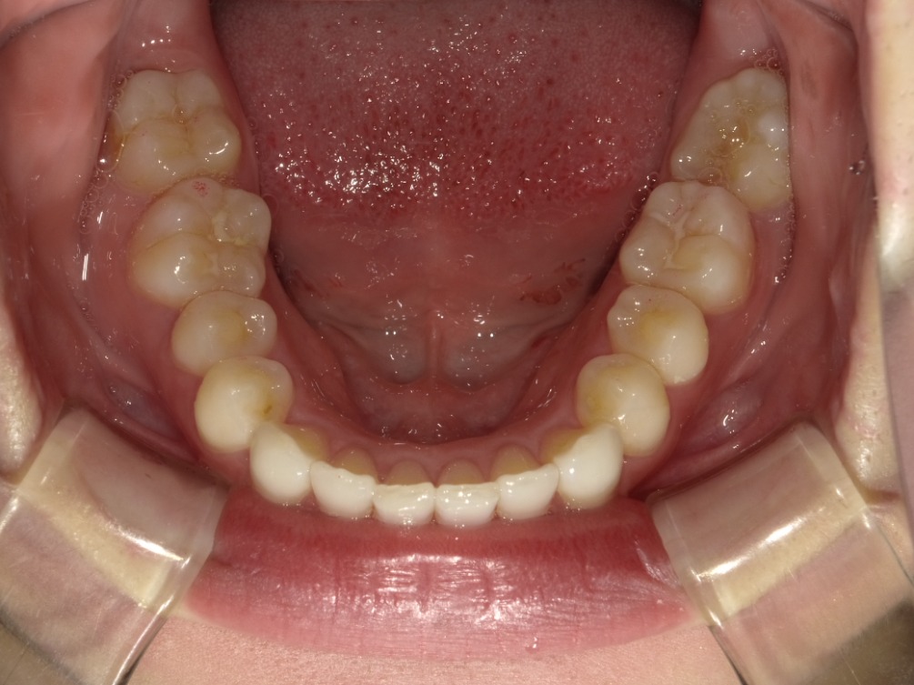 症例集　インビザライン　下顎