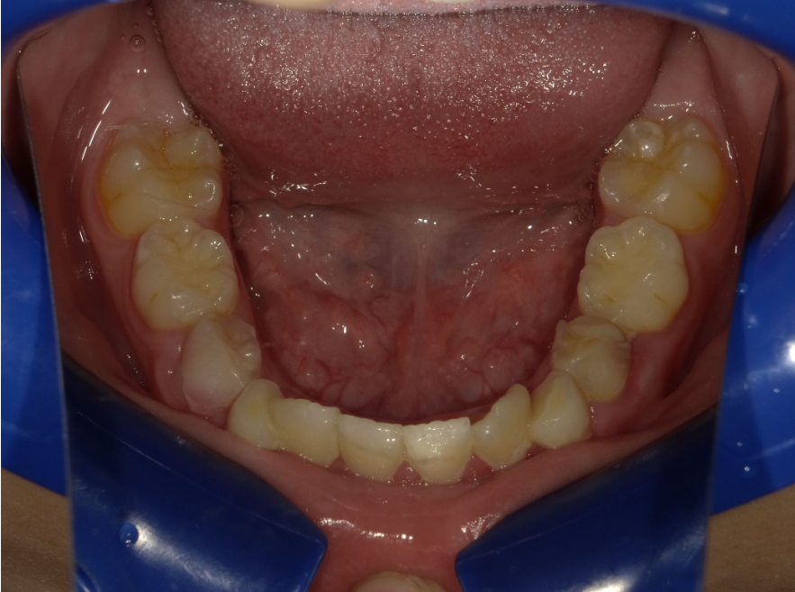 症例集　インビザライン　下顎