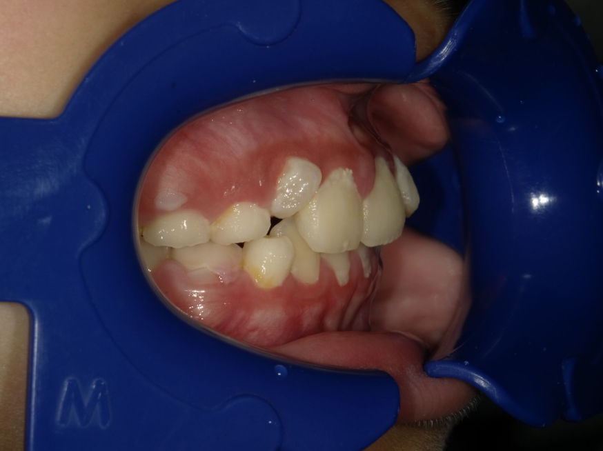 症例集　インビザライン　右横