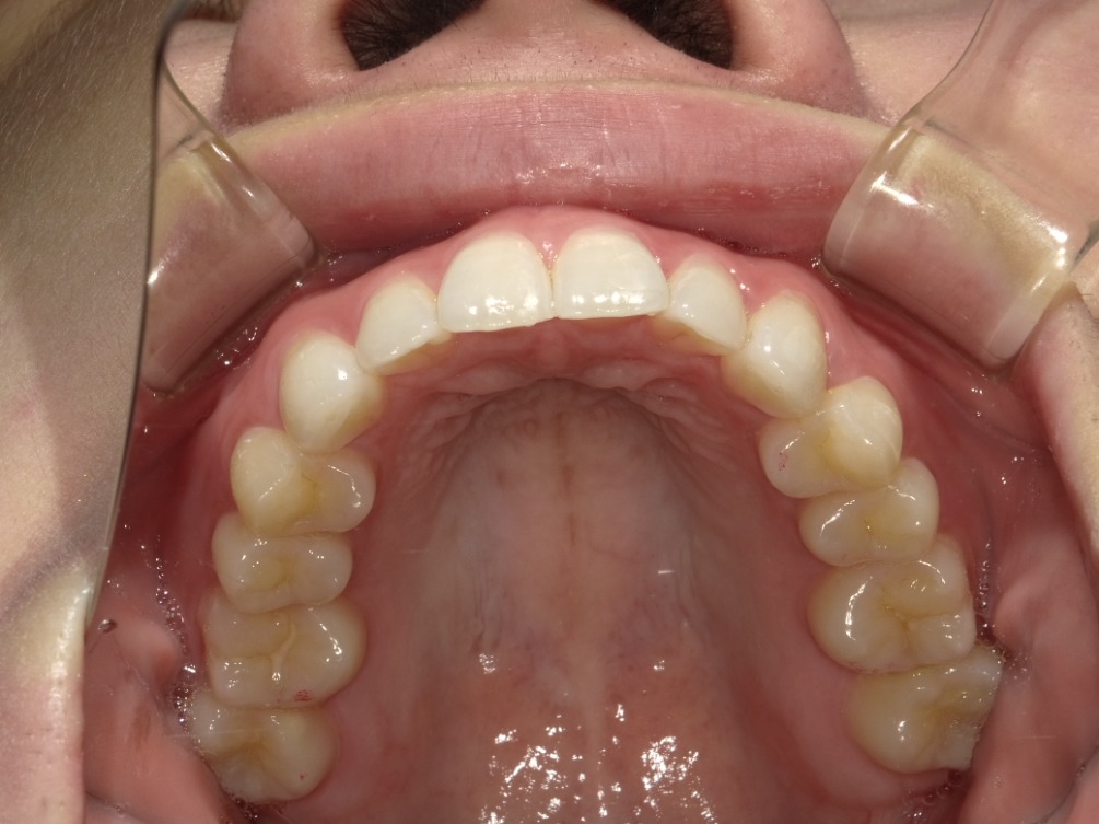 症例集　インビザライン　上顎