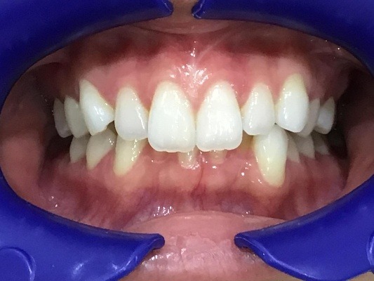 症例集　インビザライン　正面