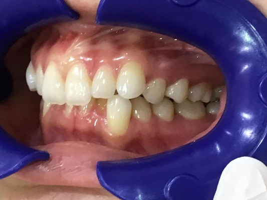 症例集　インビザライン　左横