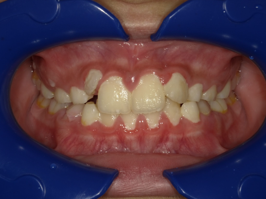 症例集　インビザライン　正面