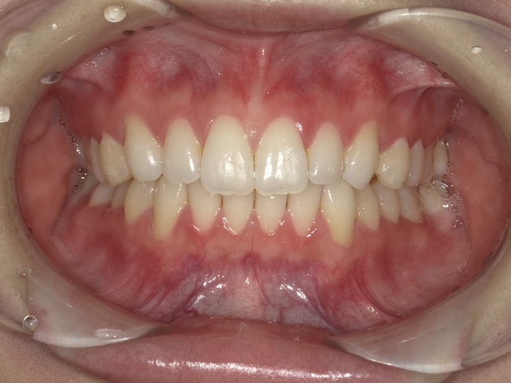 症例集　インビザライン　正面