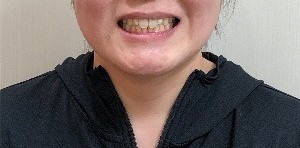症例集 インビザライン 笑顔