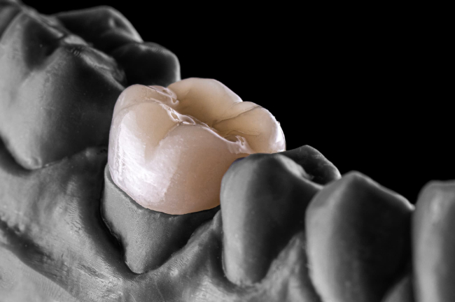 セラミックの被せ物