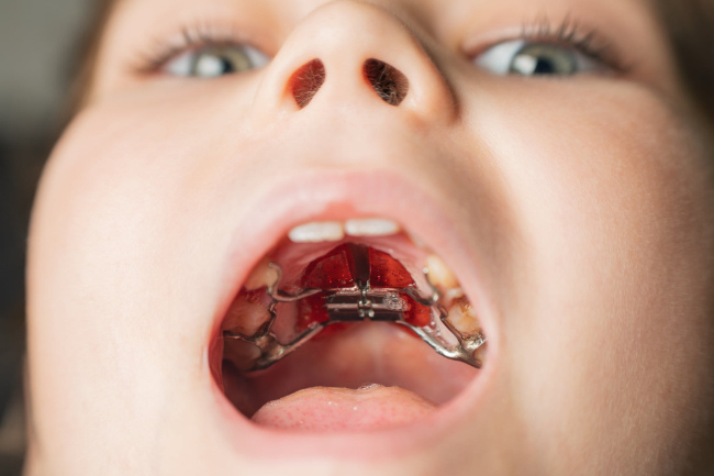 床矯正中の子どもの口内