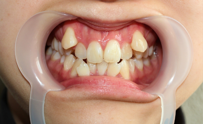 八重歯が目立つ歯並び