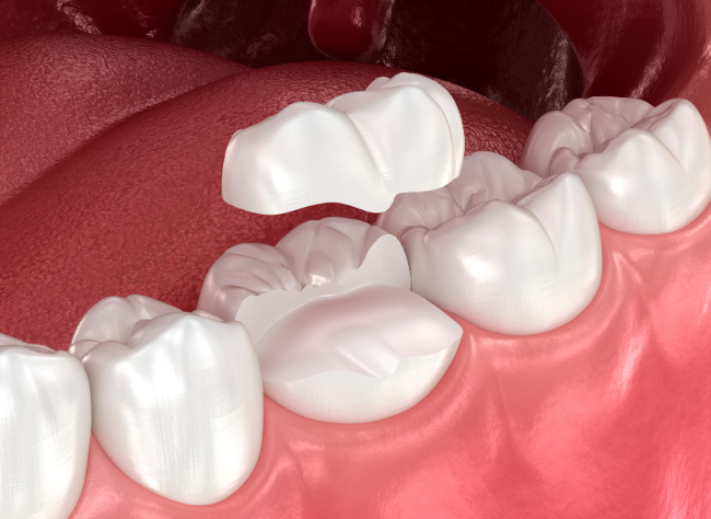 銀歯を白くするイメージ